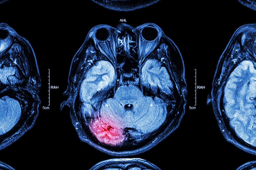 Brain injury from accident